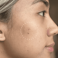 Mighty Patch™ for Dark Spots - Spot Calm